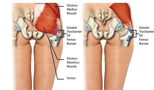 OUTER HIP PAIN, OUTER HIP PAIN [Gluteal Tendinopathy Vs. Hip Bursitis]  🙋Do you have outer hip pain? Do you have hip discomfort when lying on your  side? ✓If you have